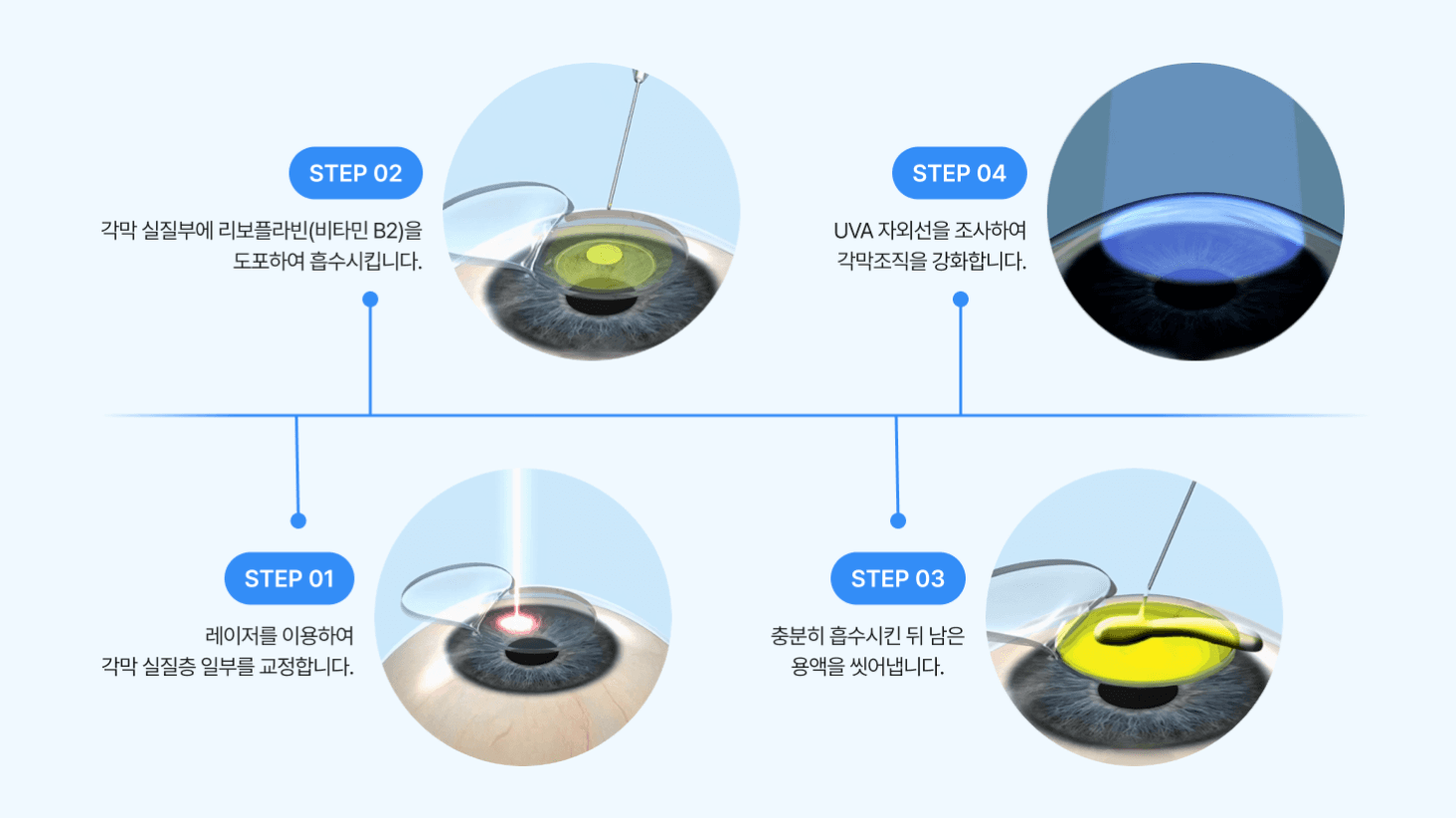 What is X-tra LASEK?