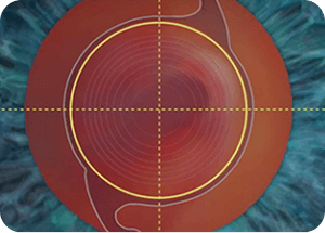 眼内レンズの正確な挿入