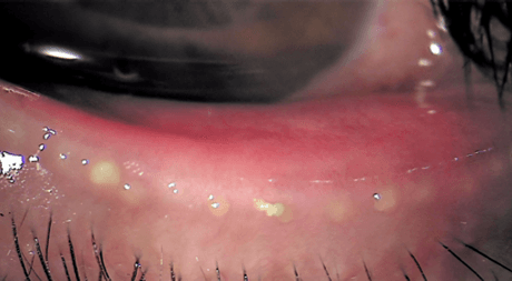 マイボーム腺機能評価