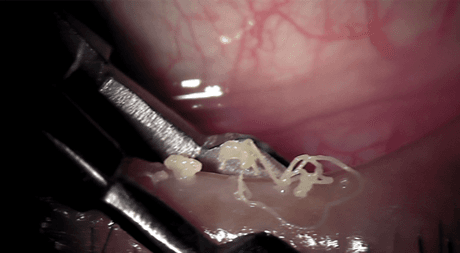 マイボーム腺圧出