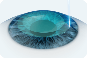 実質片を取り出すための2mmの切開窓を作成