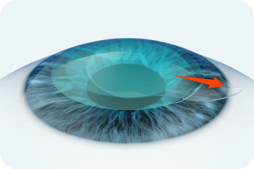 切開窓を通じて実質片(レンティキュール)を取り出す