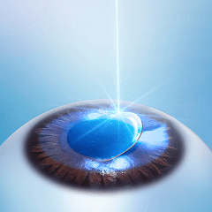 レーザーによる角膜上皮除去