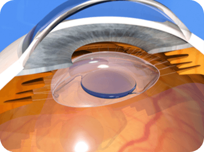 レンズ中心の精密挿入